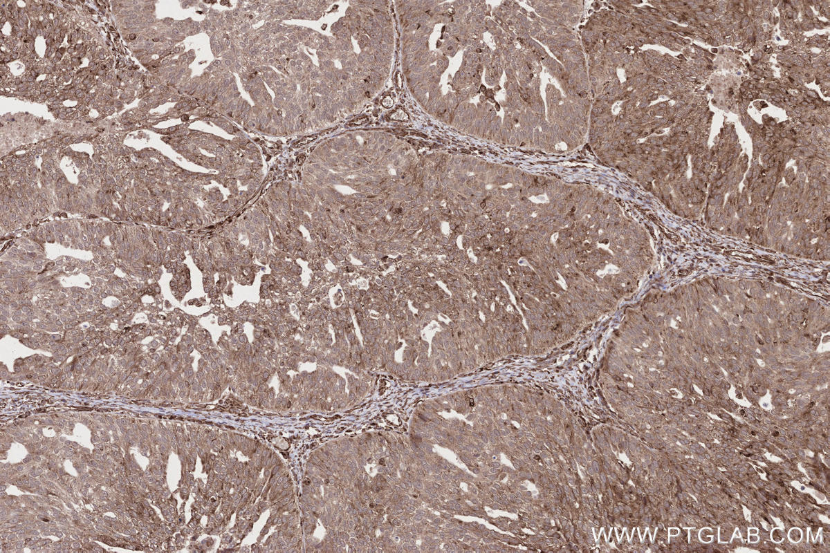 Immunohistochemical analysis of paraffin-embedded human ovary cancer tissue slide using KHC2647 (SAMD9L IHC Kit).