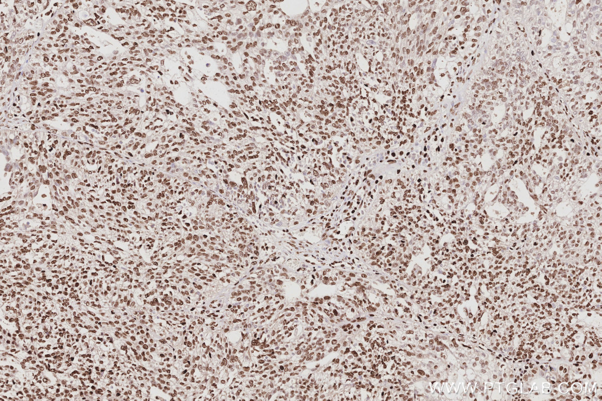 Immunohistochemical analysis of paraffin-embedded human ovary cancer tissue slide using KHC3068 (SAMHD1 IHC Kit). Immunohistochemical analysis of paraffin-embedded human ovary cancer tissue slide using KHC3068 (SAMHD1 IHC Kit).
