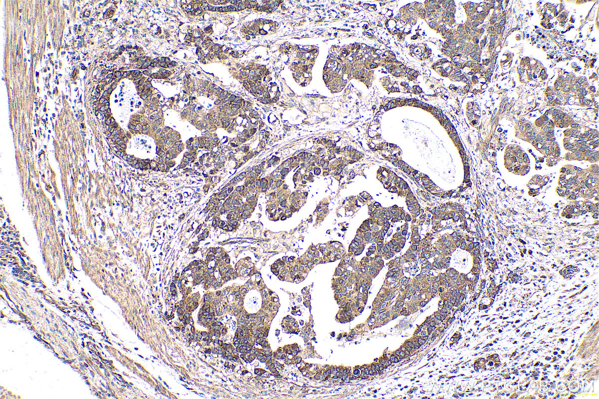 Immunohistochemical analysis of paraffin-embedded human stomach cancer tissue slide using KHC0705 (SAR1A IHC Kit).