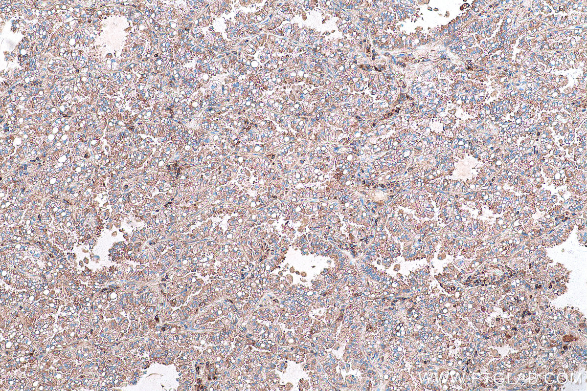 Immunohistochemical analysis of paraffin-embedded human lung cancer tissue slide using KHC0952 (SARS IHC Kit).