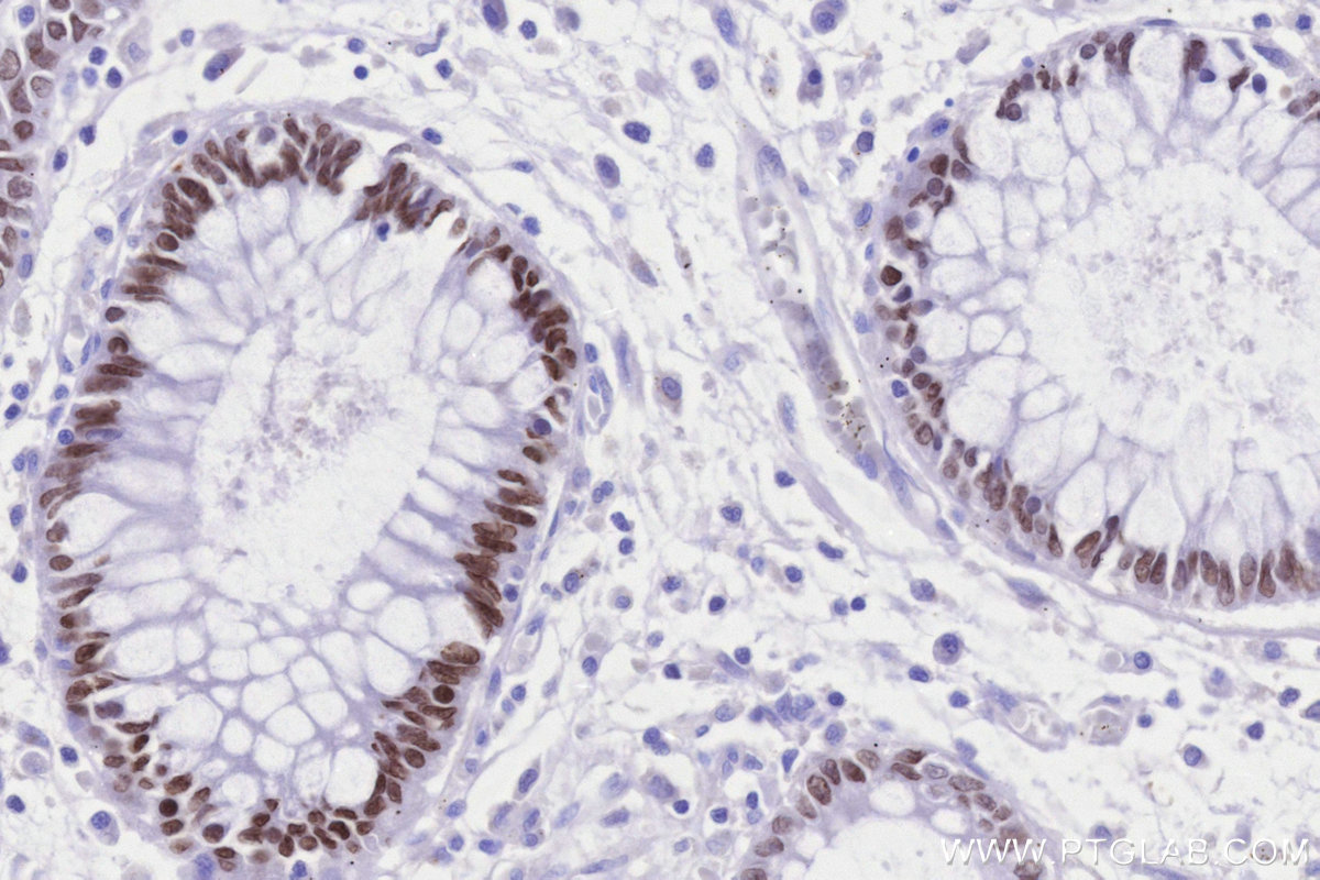 Immunohistochemical analysis of paraffin-embedded human rectal cancer tissue slide using KHC3314 (SATB2 IHC Kit). Immunohistochemical analysis of paraffin-embedded human rectal cancer tissue slide using KHC3314 (SATB2 IHC Kit).