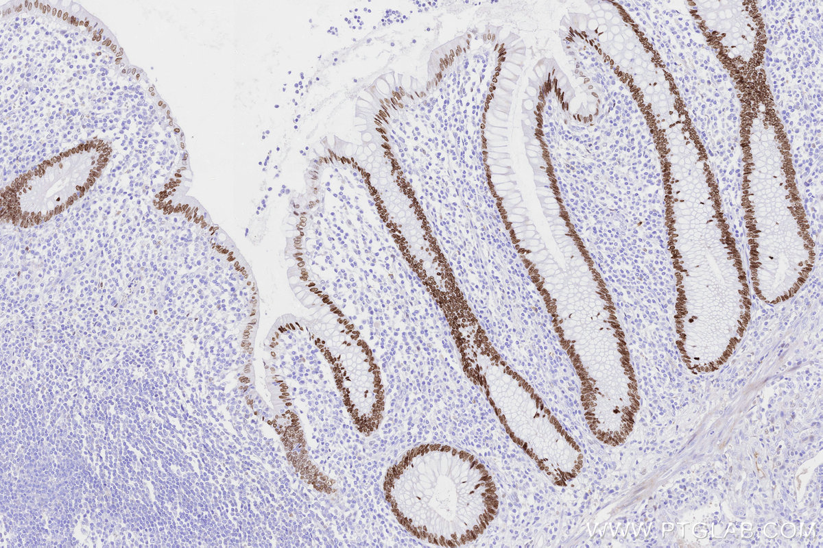 Immunohistochemical analysis of paraffin-embedded human appendicitis tissue slide using KHC3314 (SATB2 IHC Kit). Immunohistochemical analysis of paraffin-embedded human appendicitis tissue slide using KHC3314 (SATB2 IHC Kit).