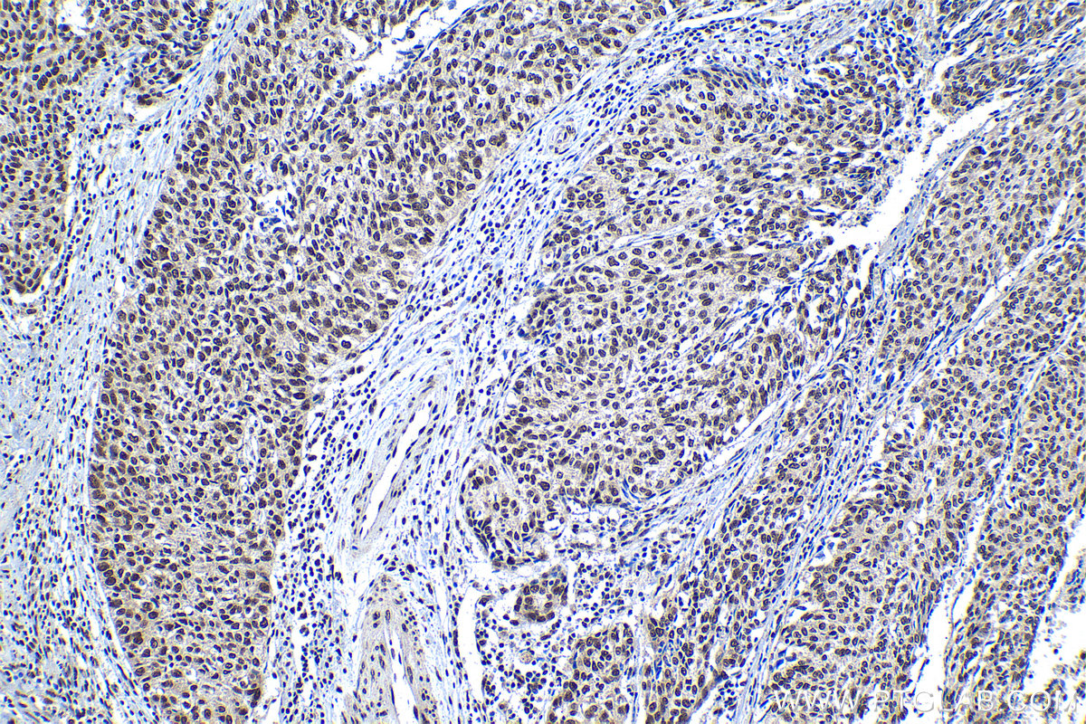 Immunohistochemical analysis of paraffin-embedded human cervical cancer tissue slide using KHC1286 (SCAF8 IHC Kit).