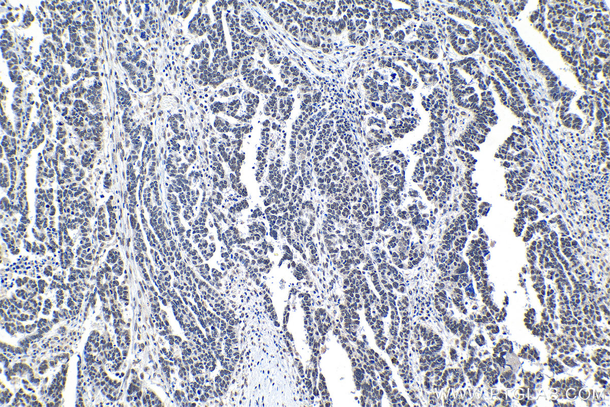 Immunohistochemical analysis of paraffin-embedded human ovary tumor tissue slide using KHC1286 (SCAF8 IHC Kit).