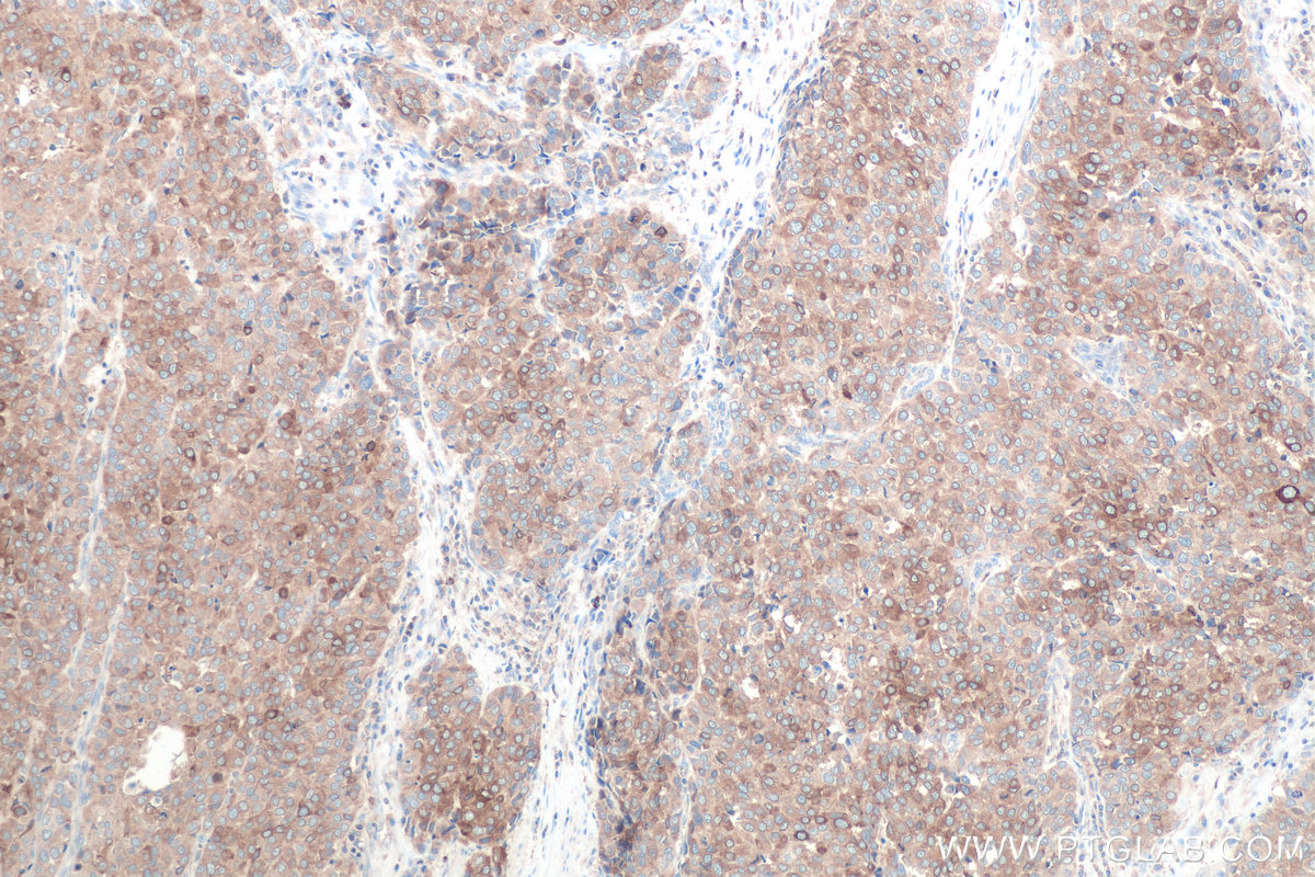 Immunohistochemical analysis of paraffin-embedded human stomach cancer tissue slide using KHC0814 (SCD IHC Kit).