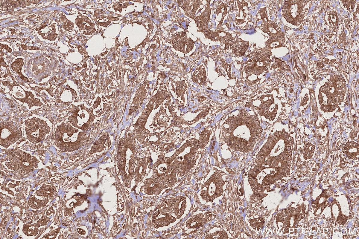 Immunohistochemical analysis of paraffin-embedded human rectal cancer tissue slide using KHC2736 (SCFD1 IHC Kit).