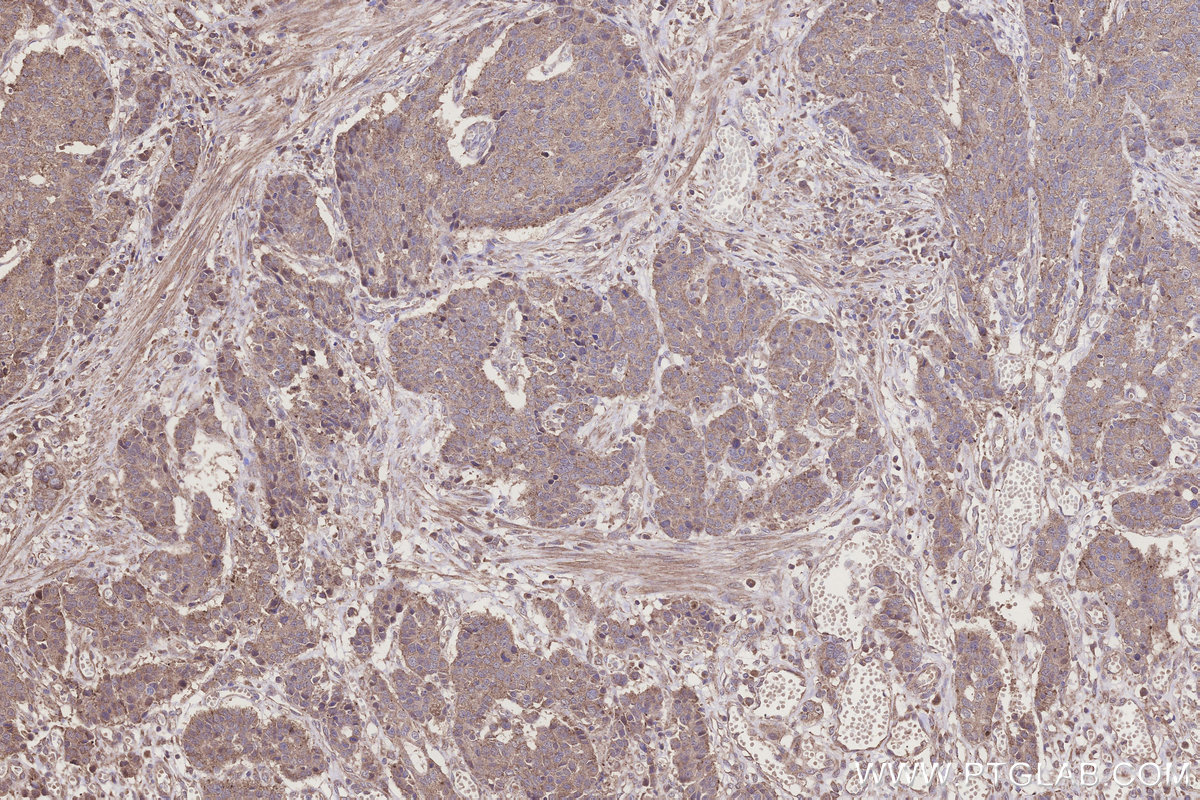 Immunohistochemical analysis of paraffin-embedded human stomach cancer tissue slide using KHC3198 (SCP2/SCPx IHC Kit).