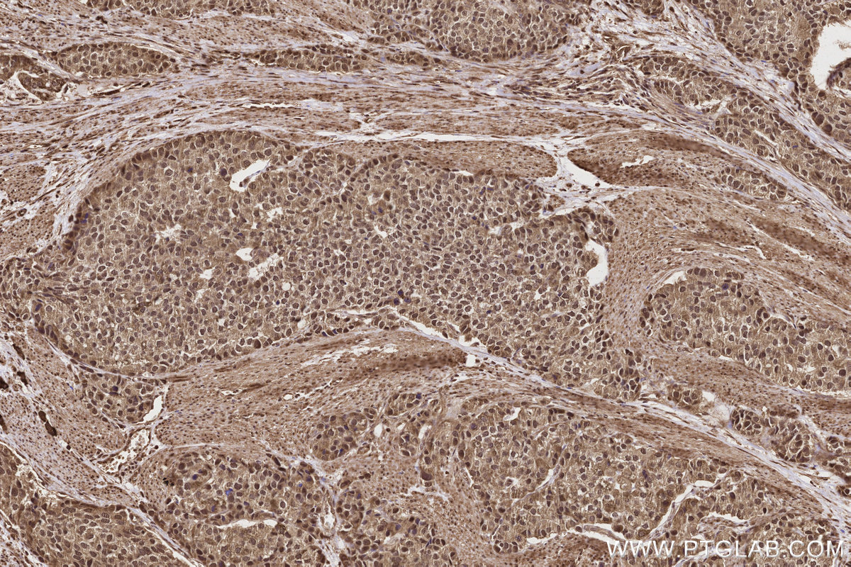 Immunohistochemical analysis of paraffin-embedded human stomach cancer tissue slide using KHC2803 (SCYL1 IHC Kit).