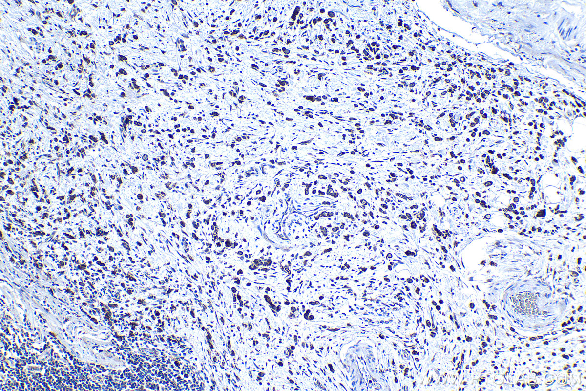 Immunohistochemical analysis of paraffin-embedded human stomach cancer tissue slide using KHC1250 (SDF4 IHC Kit).