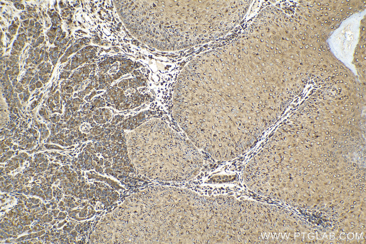 Immunohistochemical analysis of paraffin-embedded human malignant melanoma tissue slide using KHC2112 (SEC22B IHC Kit).