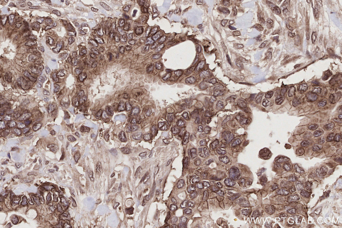 Immunohistochemical analysis of paraffin-embedded human rectal cancer tissue slide using KHC2789 (SEH1L IHC Kit). Immunohistochemical analysis of paraffin-embedded human rectal cancer tissue slide using KHC2789 (SEH1L IHC Kit).