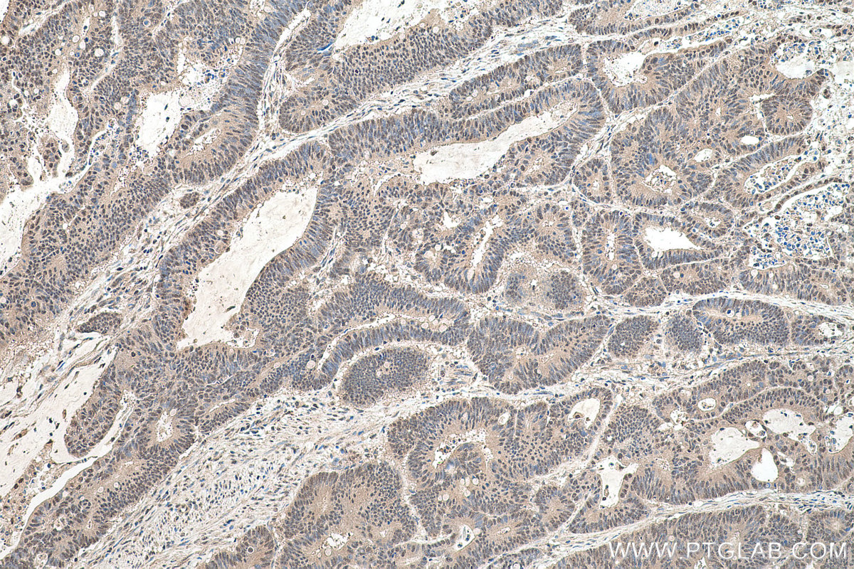 Immunohistochemical analysis of paraffin-embedded human colon cancer tissue slide using KHC0574 (SELENBP1 IHC Kit).