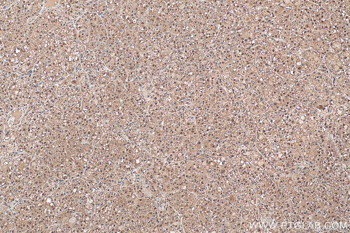 Immunohistochemical analysis of paraffin-embedded human liver cancer tissue slide using KHC0574 (SELENBP1 IHC Kit).