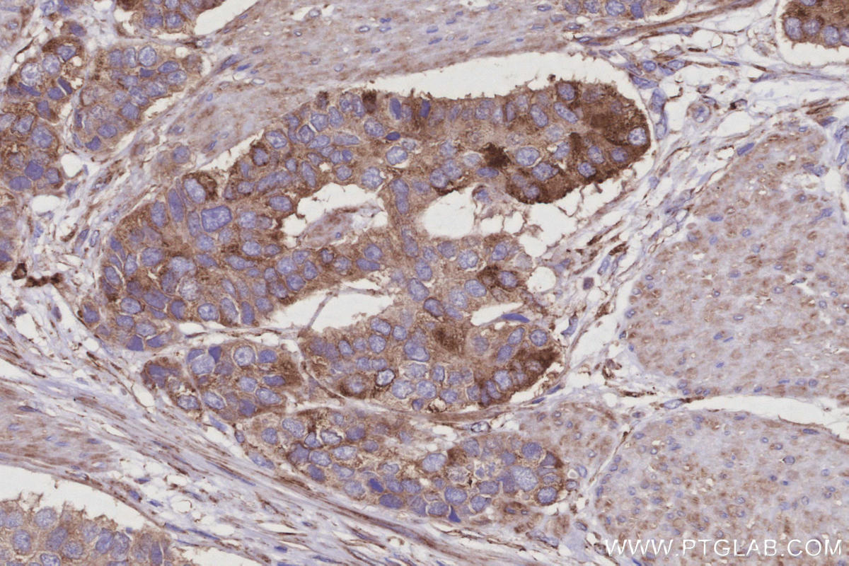 Immunohistochemical analysis of paraffin-embedded human stomach cancer tissue slide using KHC2957 (SEPT11 IHC Kit). Immunohistochemical analysis of paraffin-embedded human stomach cancer tissue slide using KHC2957 (SEPT11 IHC Kit).