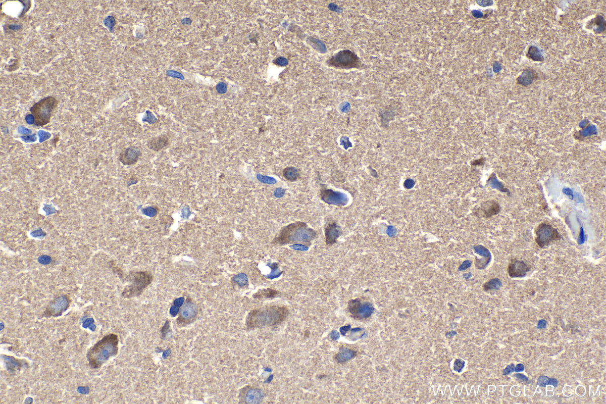 Immunohistochemical analysis of paraffin-embedded human gliomas tissue slide using KHC0995 (SEPT7 IHC Kit).