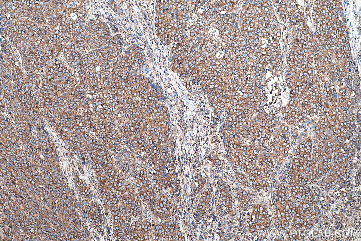 Immunohistochemical analysis of paraffin-embedded human stomach cancer tissue slide using KHC0726 (SEPTIN2 IHC Kit).