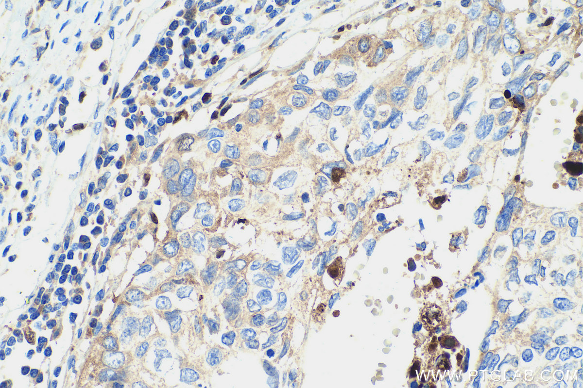 Immunohistochemical analysis of paraffin-embedded human cervical cancer tissue slide using KHC0458 (Alpha Antichymotrypsin IHC Kit).