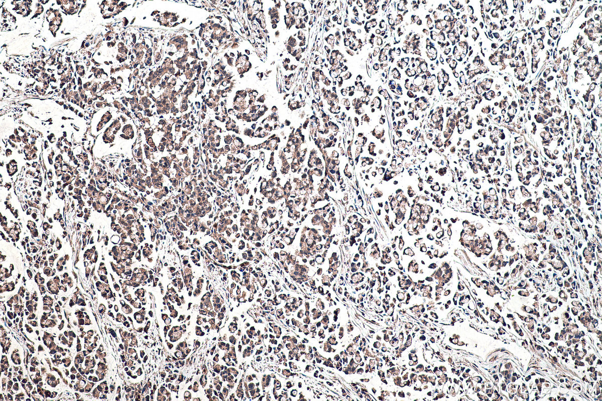 Immunohistochemical analysis of paraffin-embedded human colon cancer tissue slide using KHC0459 (SERPINB8 IHC Kit).