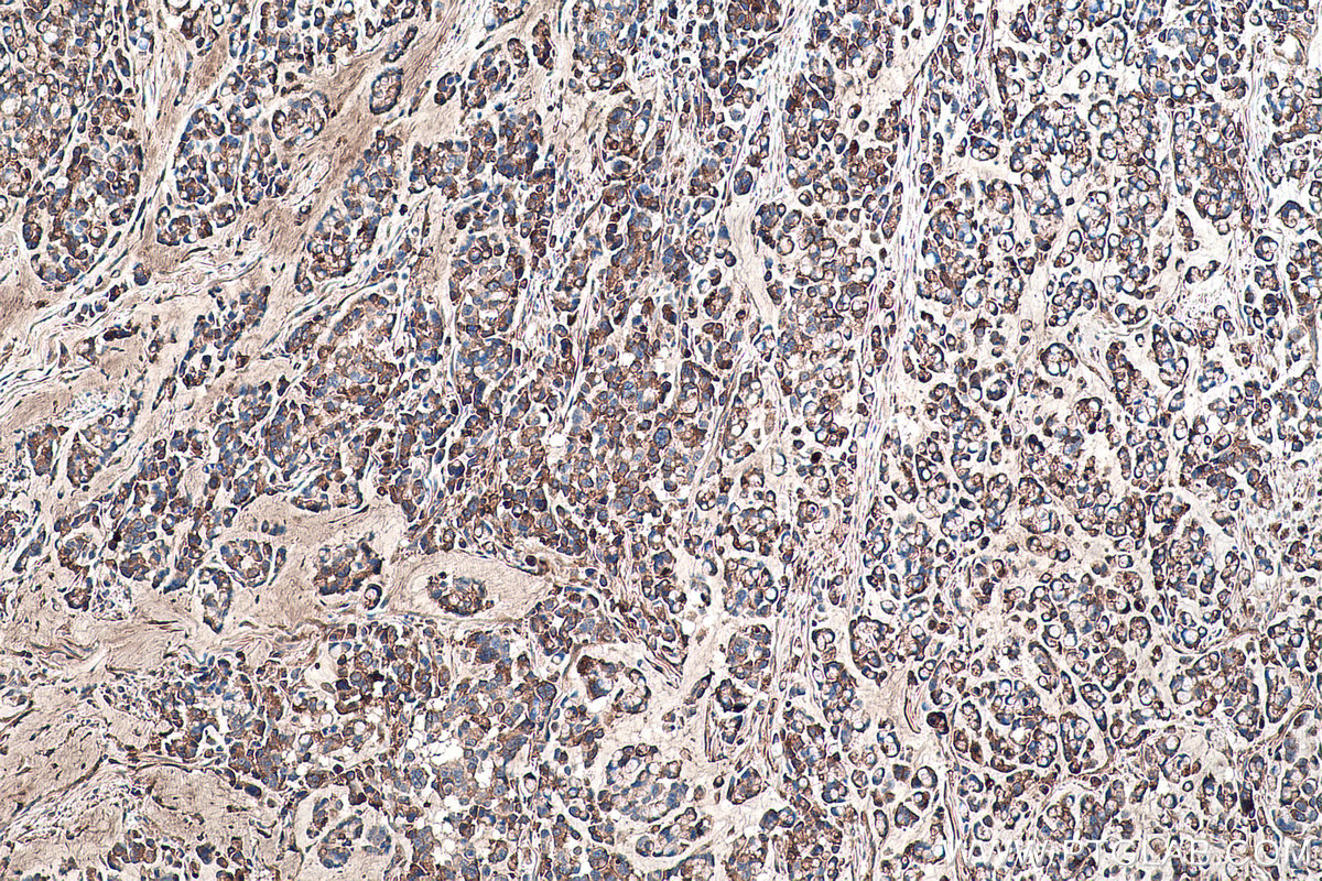 Immunohistochemical analysis of paraffin-embedded human colon cancer tissue slide using KHC0460 (SERPINC1 IHC Kit).