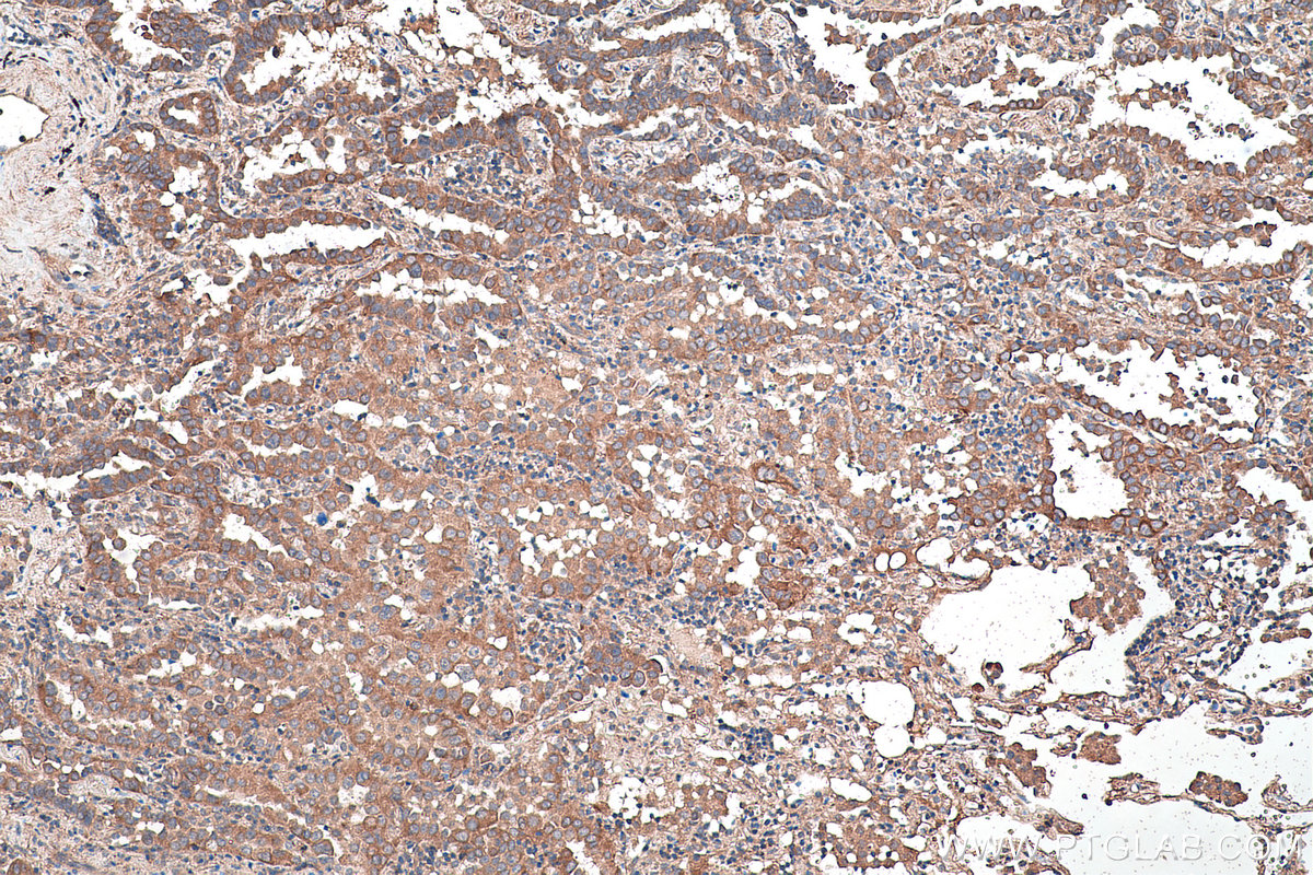 Immunohistochemical analysis of paraffin-embedded human lung cancer tissue slide using KHC0461 (SERPINE1 IHC Kit).