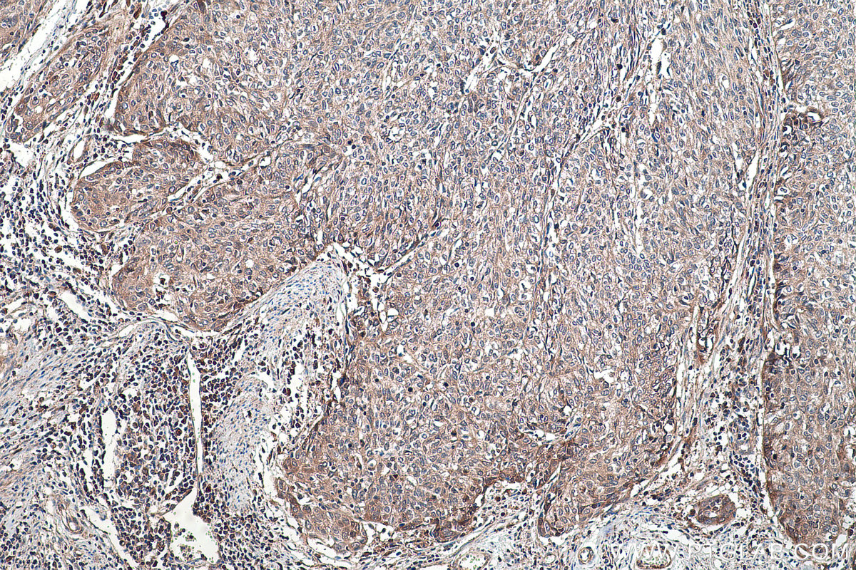 Immunohistochemical analysis of paraffin-embedded human cervical cancer tissue slide using KHC0462 (SERPINF1/PEDF IHC Kit).