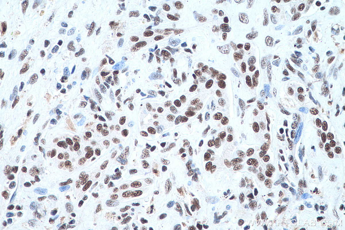 Immunohistochemical analysis of paraffin-embedded human liver cancer tissue slide using KHC0696 (SET IHC Kit).