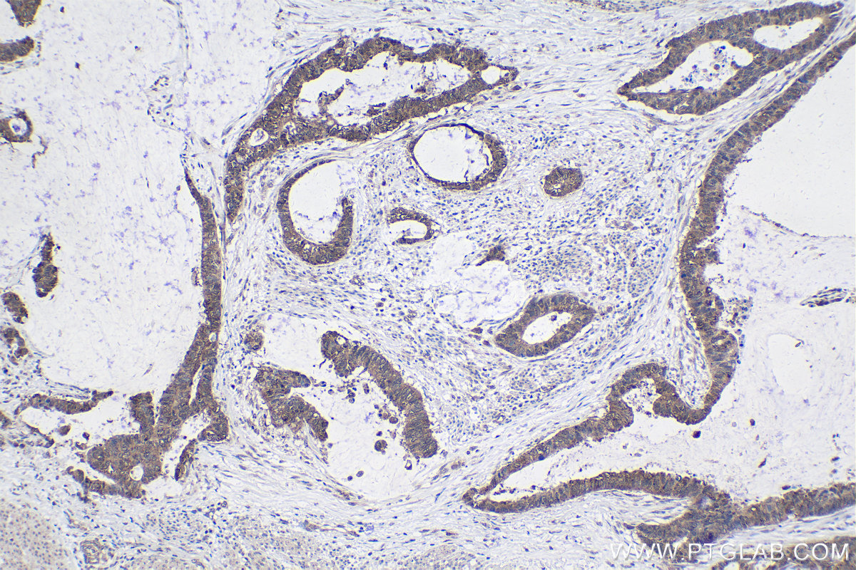 Immunohistochemical analysis of paraffin-embedded human urothelial carcinoma tissue slide using KHC1801 (SETX IHC Kit).