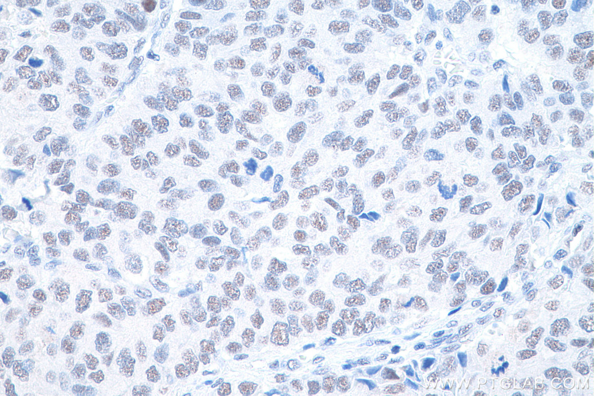 Immunohistochemical analysis of paraffin-embedded human stomach cancer tissue slide using KHC0906 (SF3A1 IHC Kit).