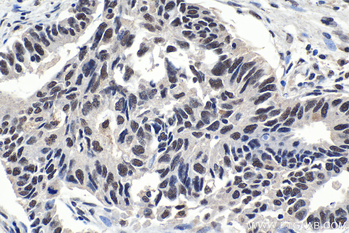 Immunohistochemical analysis of paraffin-embedded human lung cancer tissue slide using KHC1077 (SF3B1 IHC Kit).