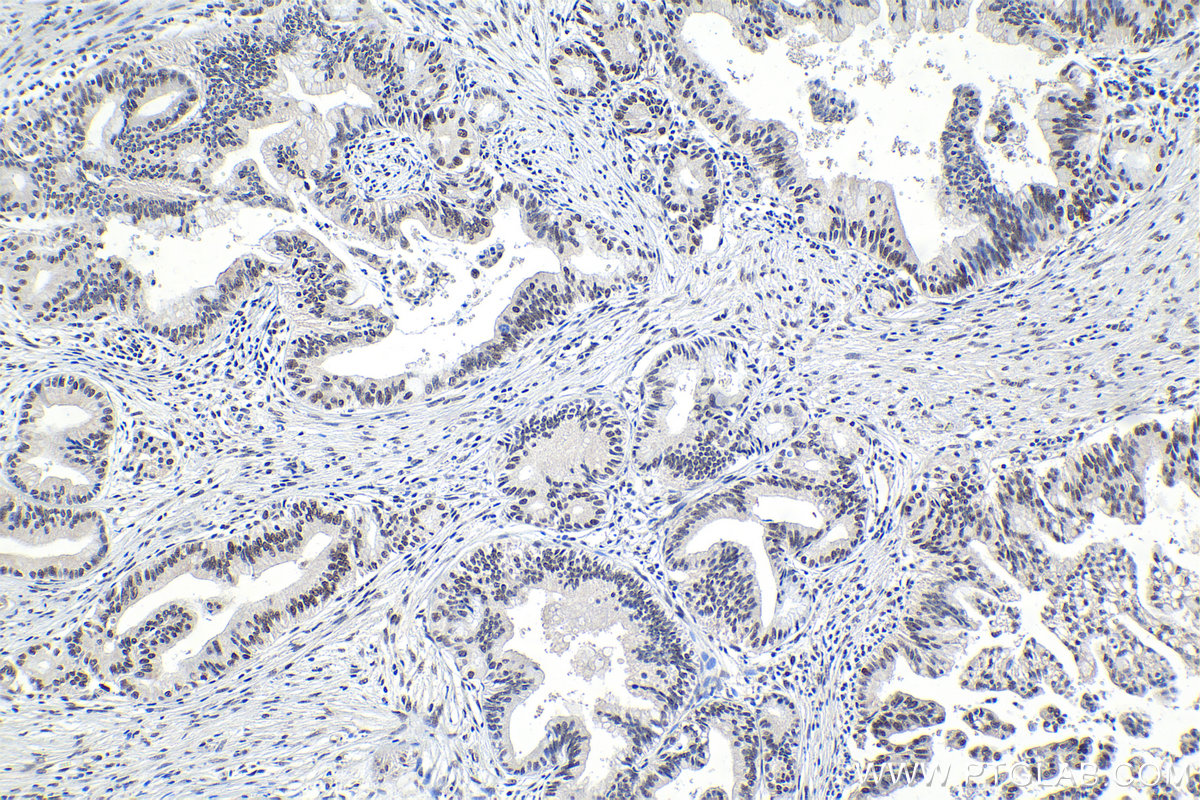 Immunohistochemical analysis of paraffin-embedded human pancreas cancer tissue slide using KHC1077 (SF3B1 IHC Kit).