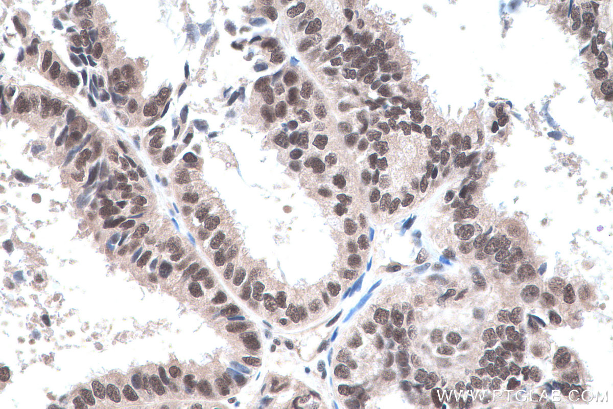 Immunohistochemical analysis of paraffin-embedded human ovary tumor tissue slide using KHC0463 (SF3B5 IHC Kit).