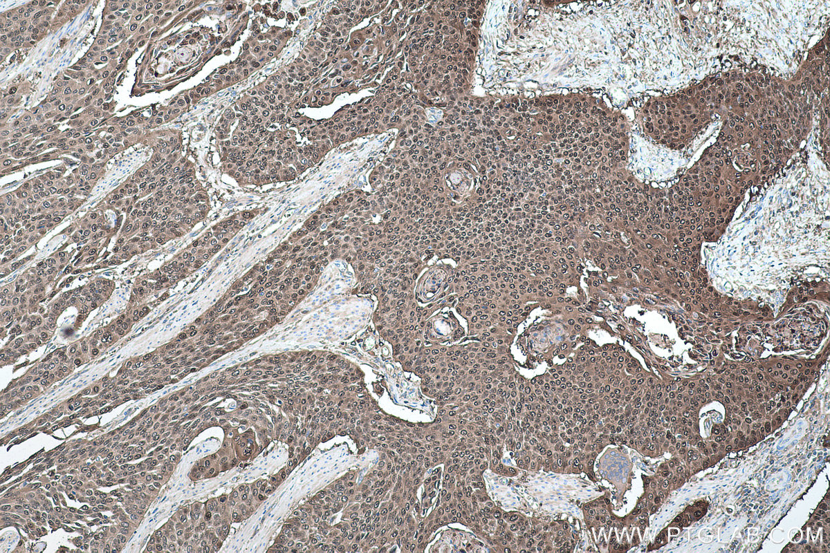 Immunohistochemical analysis of paraffin-embedded human oesophagus cancer tissue slide using KHC0464 (14-3-3 Sigma IHC Kit).