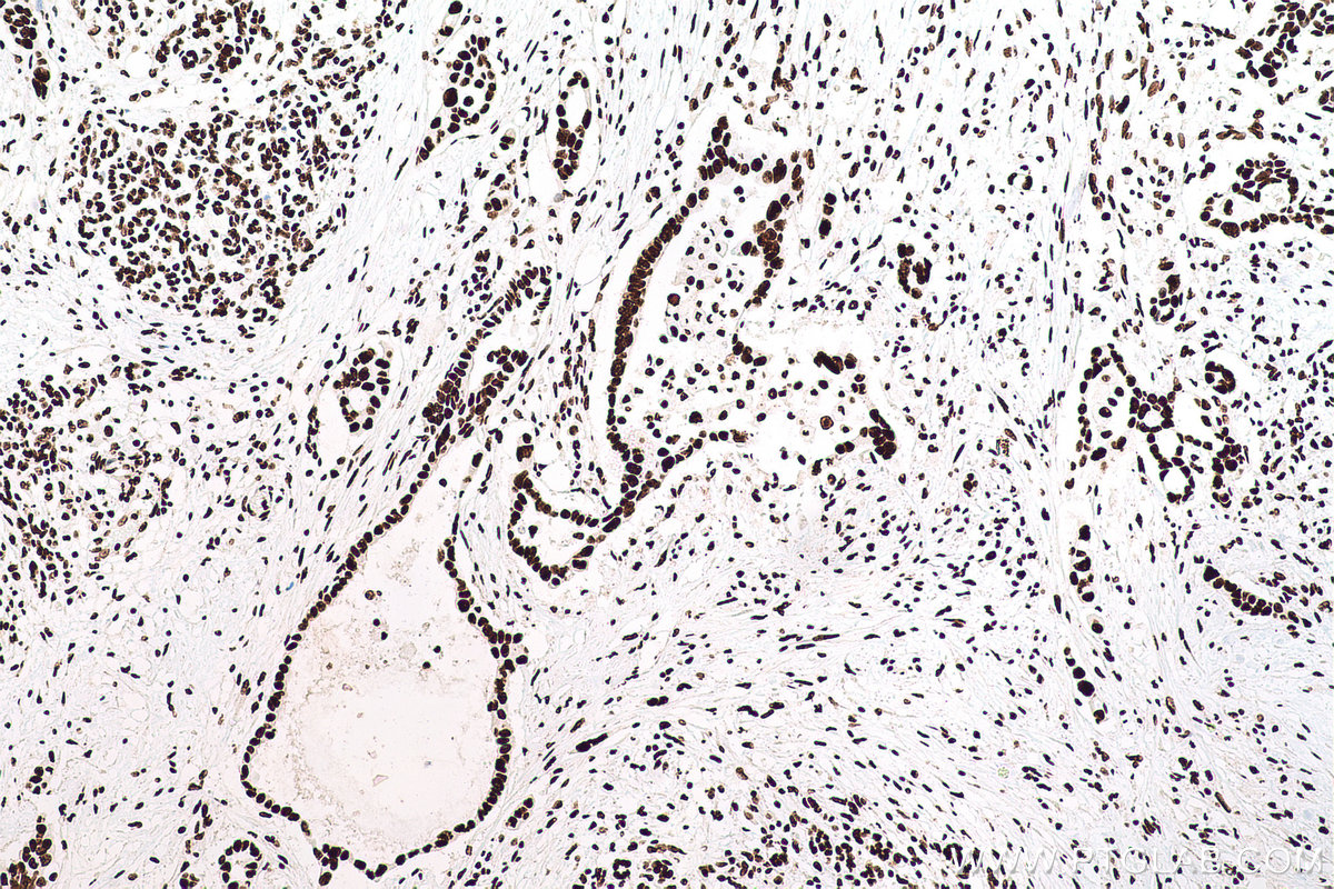 Immunohistochemical analysis of paraffin-embedded human pancreas cancer tissue slide using KHC0710 (SFPQ IHC Kit).