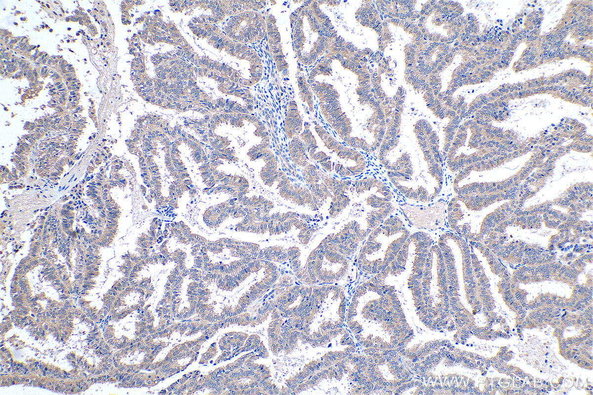Immunohistochemical analysis of paraffin-embedded human ovary tumor tissue slide using KHC0475 (SFRP4 IHC Kit).