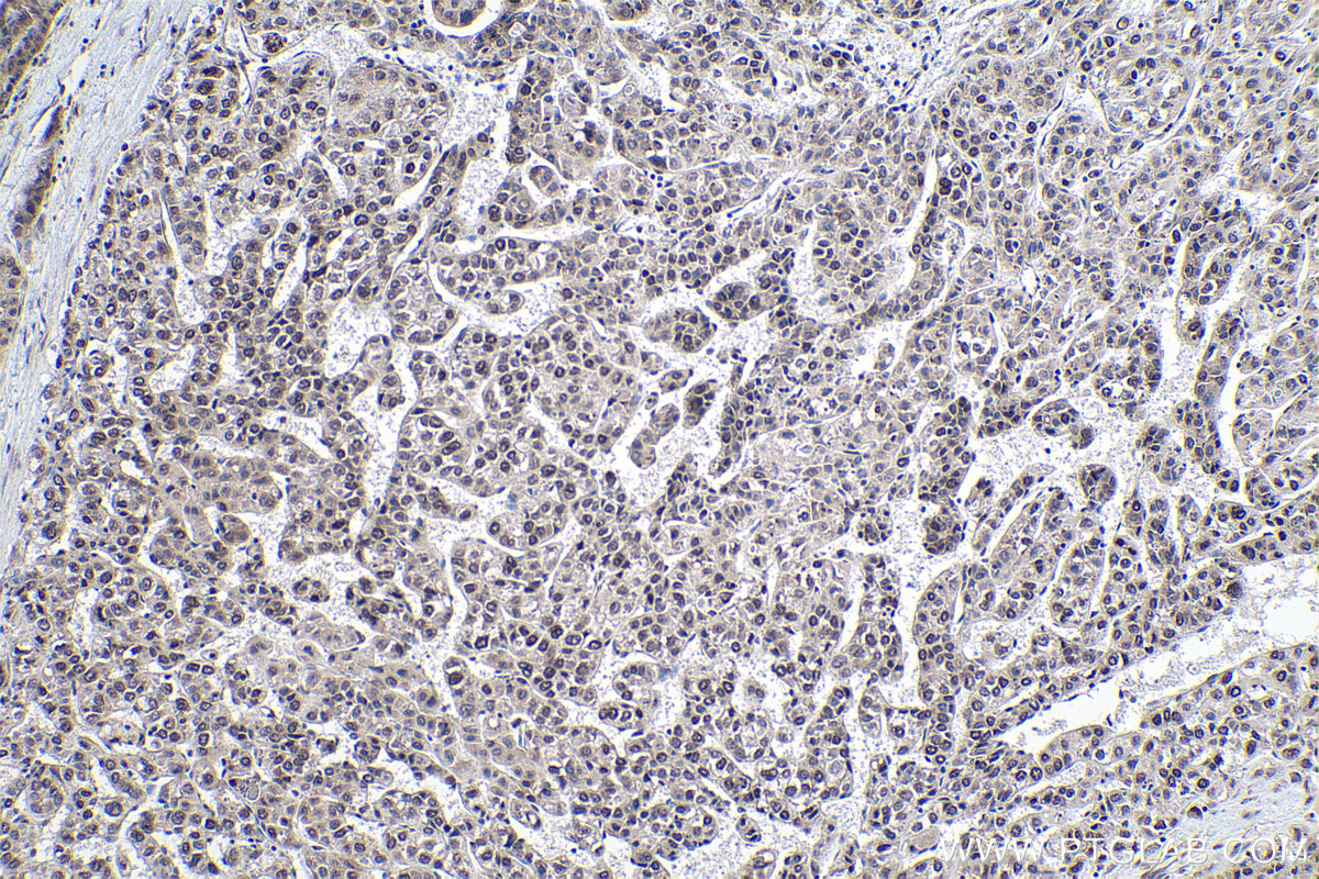 Immunohistochemical analysis of paraffin-embedded human liver cancer tissue slide using KHC0165 (SFRS2 IHC Kit).