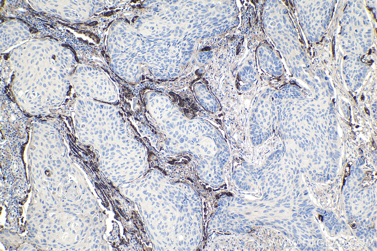 Immunohistochemical analysis of paraffin-embedded human lung cancer tissue slide using KHC1054 (SFTPD IHC Kit).