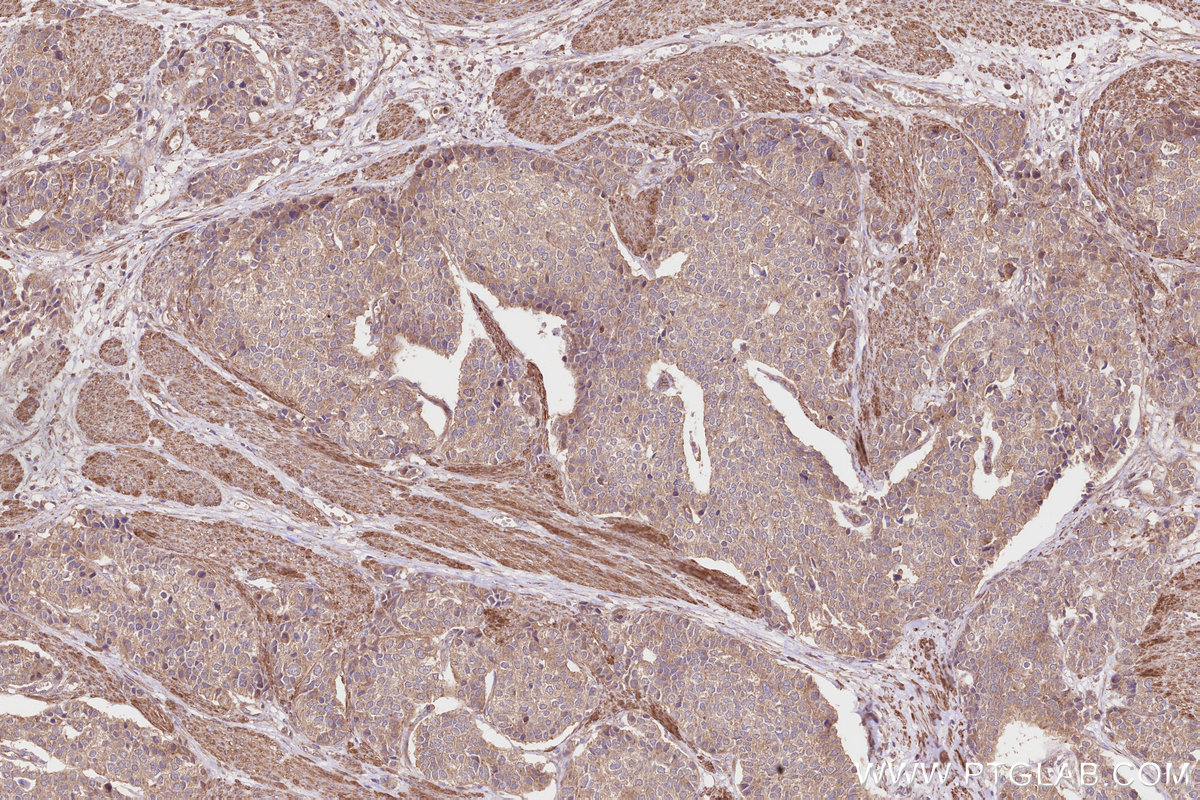Immunohistochemical analysis of paraffin-embedded human stomach cancer tissue slide using KHC2798 (SGSM3 IHC Kit).