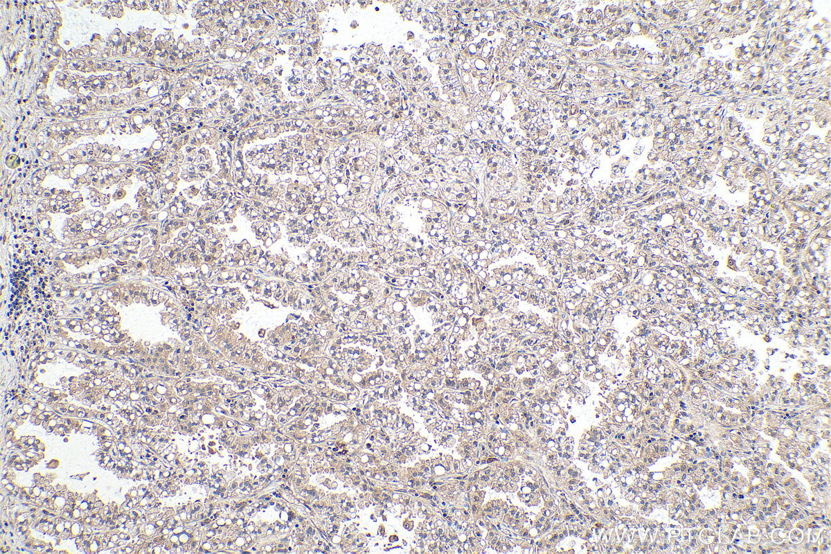 Immunohistochemical analysis of paraffin-embedded human lung cancer tissue slide using KHC0875 (SGTA IHC Kit).