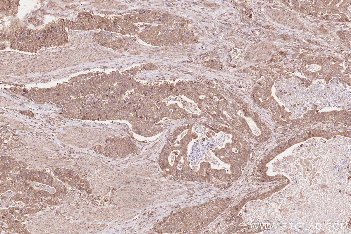 Immunohistochemical analysis of paraffin-embedded human stomach cancer tissue slide using KHC2604 (SHLD3 IHC Kit).