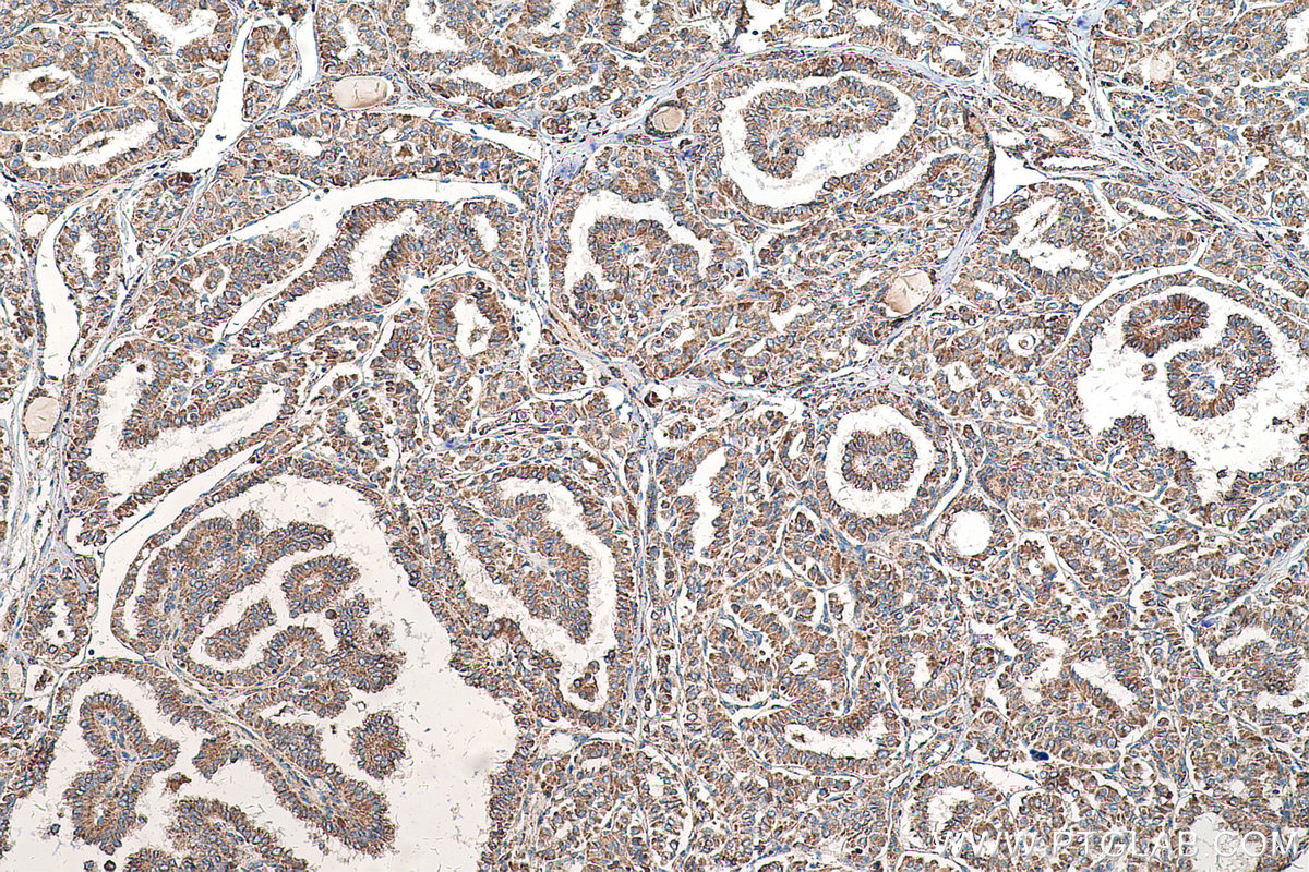 Immunohistochemical analysis of paraffin-embedded human thyroid cancer tissue slide using KHC0566 (SHMT1 IHC Kit).