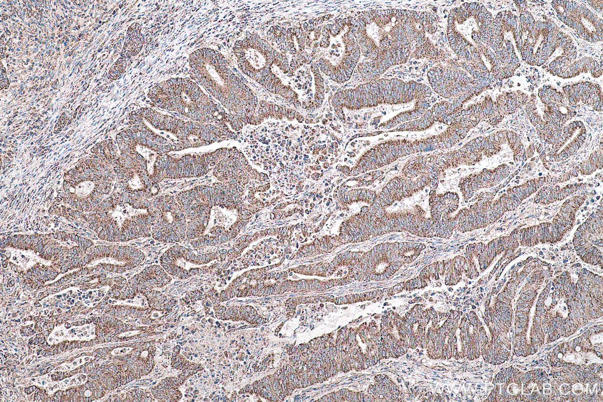 Immunohistochemical analysis of paraffin-embedded human colon cancer tissue slide using KHC0566 (SHMT1 IHC Kit).