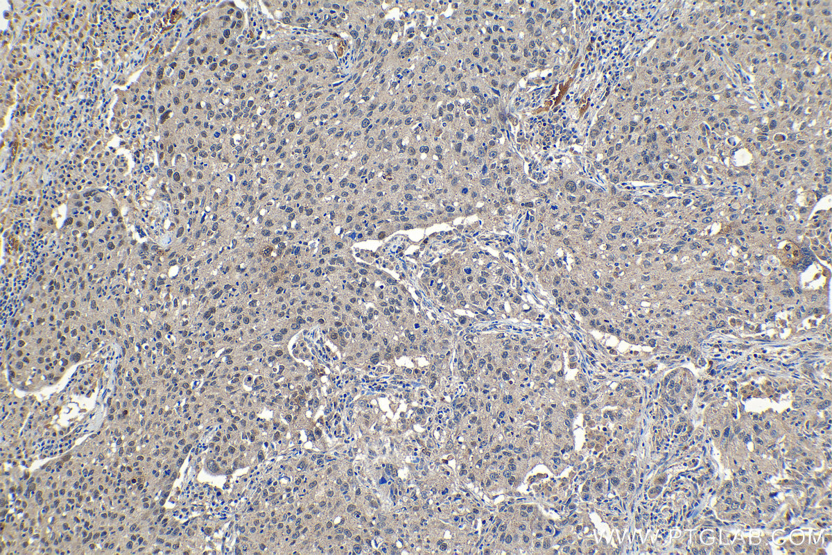 Immunohistochemical analysis of paraffin-embedded human lung cancer tissue slide using KHC1207 (SIRT1 IHC Kit).