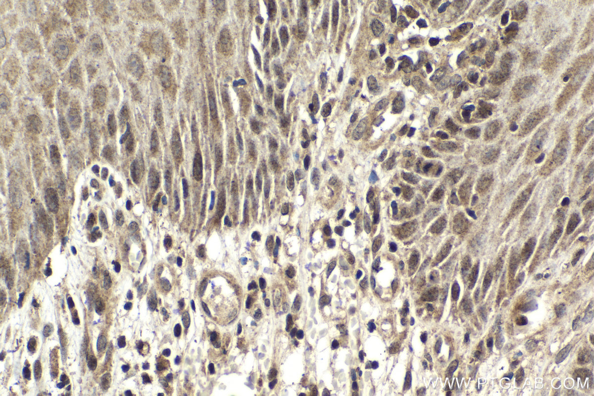Immunohistochemical analysis of paraffin-embedded human skin cancer tissue slide using KHC1988 (SIX4 IHC Kit).