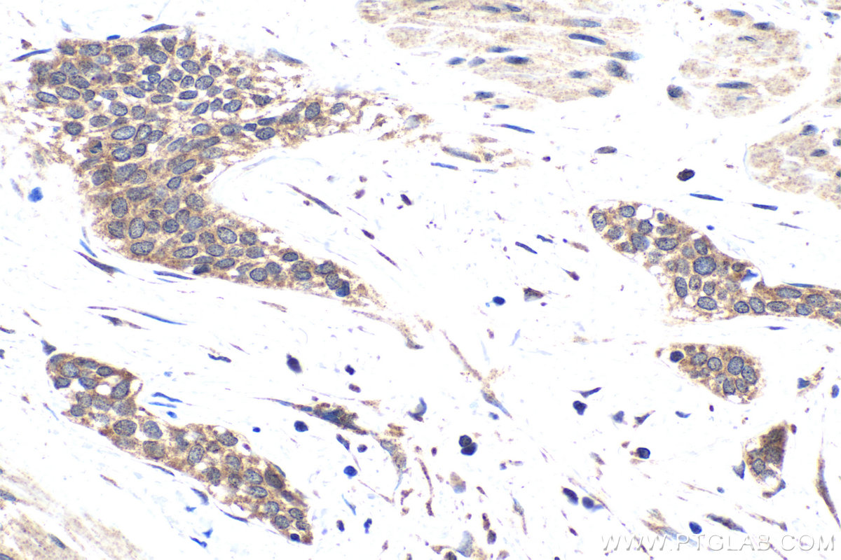 Immunohistochemical analysis of paraffin-embedded human urothelial carcinoma tissue slide using KHC1768 (SKOR2 IHC Kit).