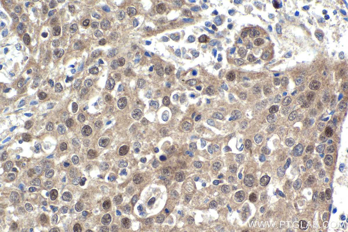 Immunohistochemical analysis of paraffin-embedded human cervical cancer tissue slide using KHC1709 (SKP2 IHC Kit).