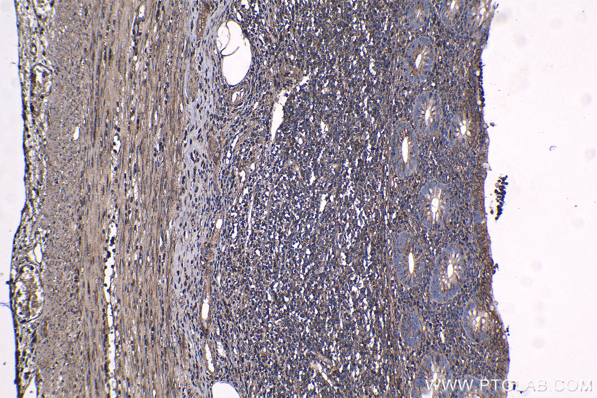 Immunohistochemical analysis of paraffin-embedded human appendicitis tissue slide using KHC1147 (SLC11A1 IHC Kit).