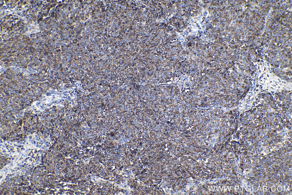 Immunohistochemical analysis of paraffin-embedded human stomach cancer tissue slide using KHC1147 (SLC11A1 IHC Kit).