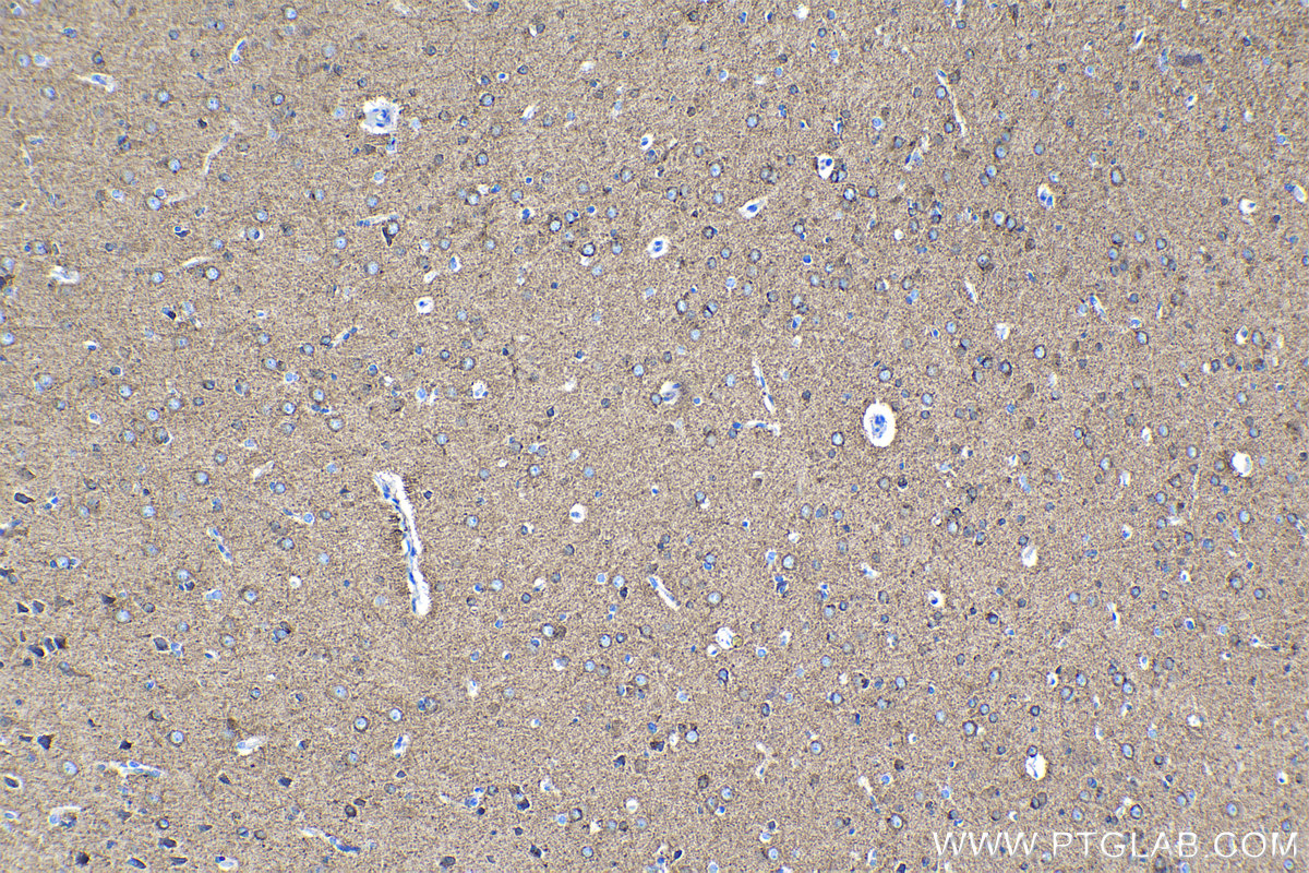 Immunohistochemical analysis of paraffin-embedded human gliomas tissue slide using KHC1344 (SLC12A5 IHC Kit).