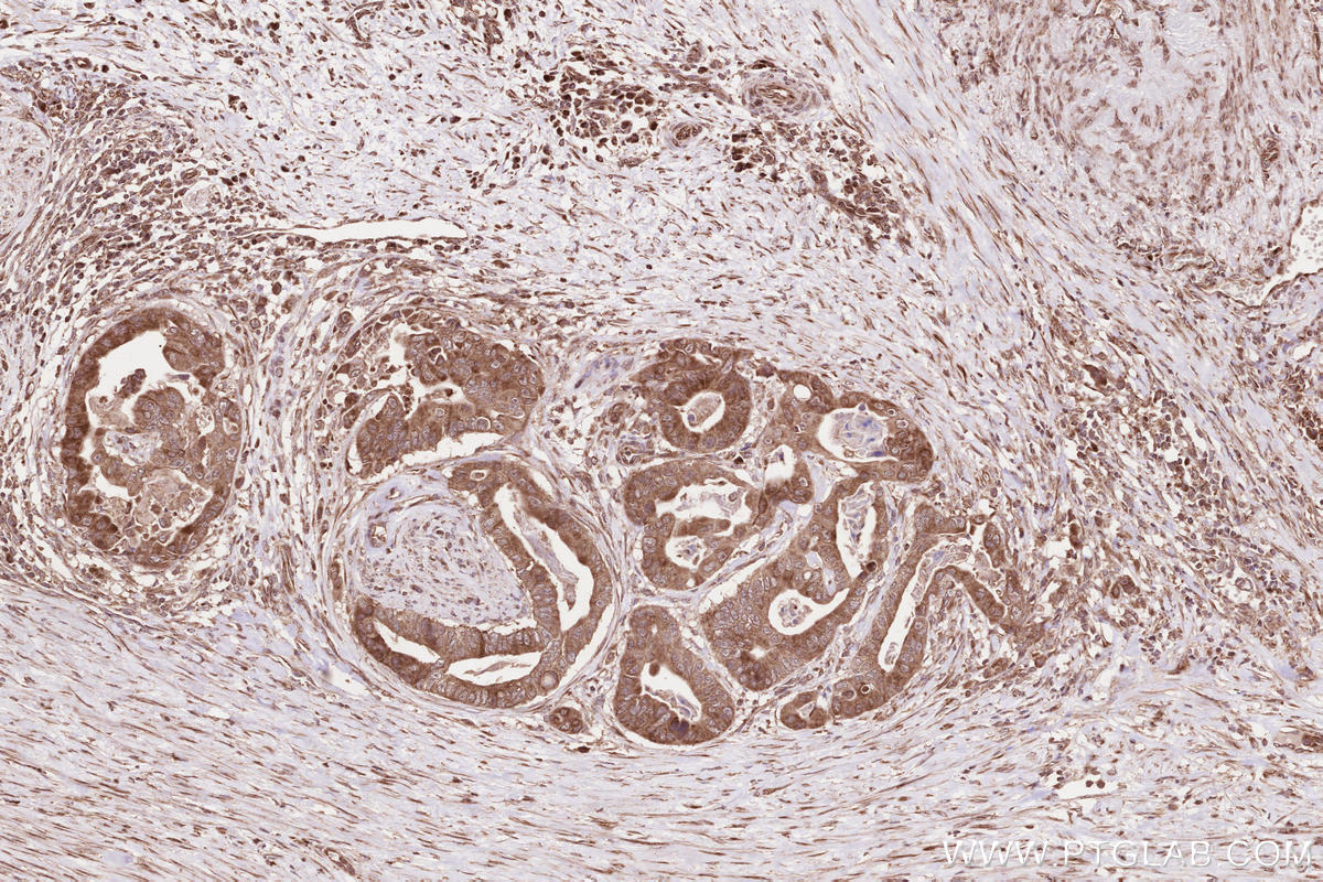 Immunohistochemical analysis of paraffin-embedded human stomach cancer tissue slide using KHC2583 (SLC30A6/ZNT6 IHC Kit).