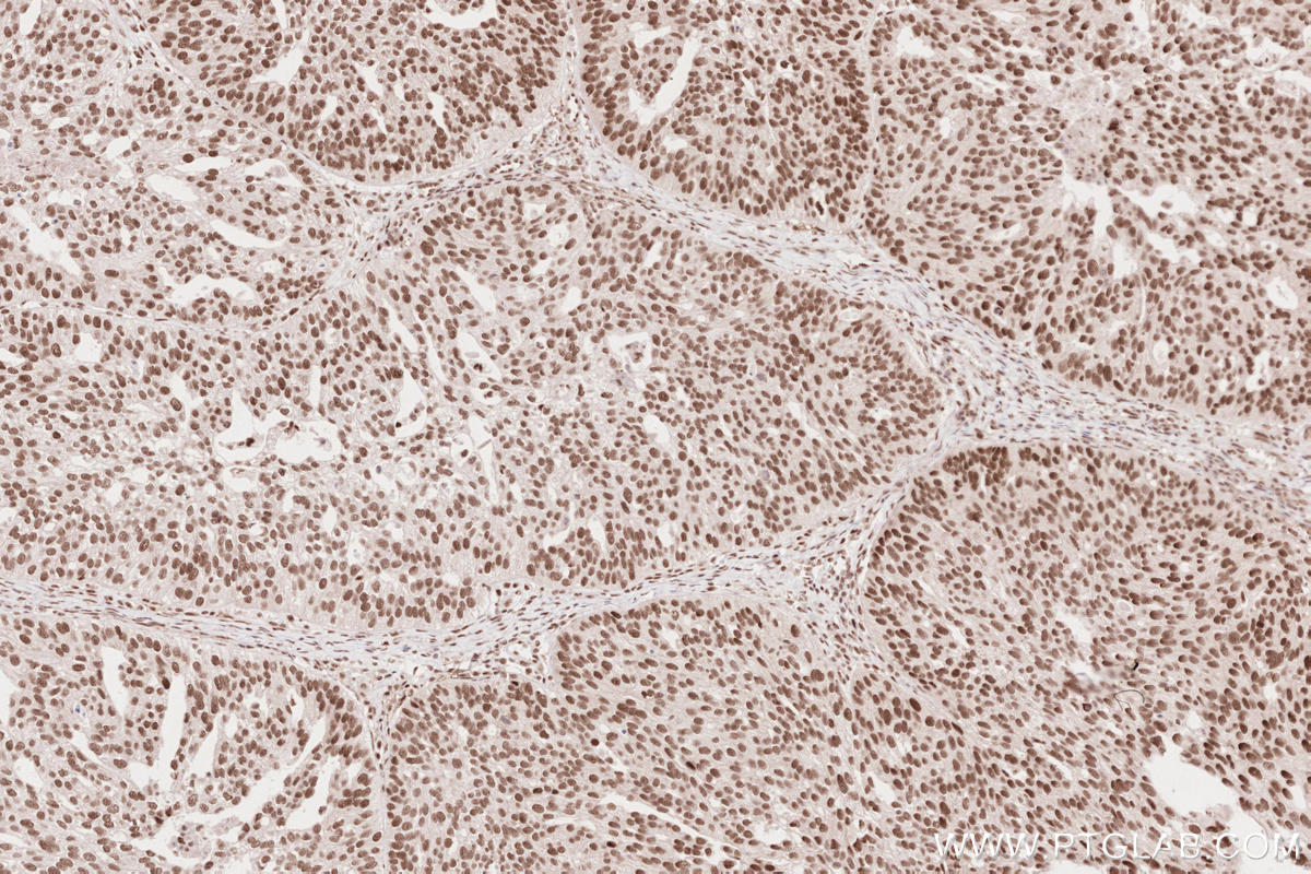 Immunohistochemical analysis of paraffin-embedded human ovary cancer tissue slide using KHC2629 (SLFN11 IHC Kit).